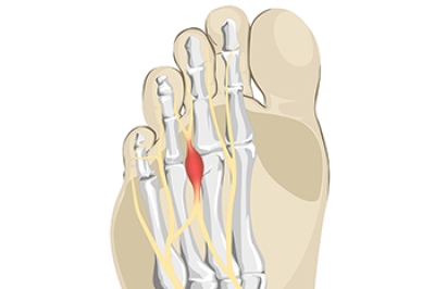 Definition and Symptoms of Morton’s Neuroma