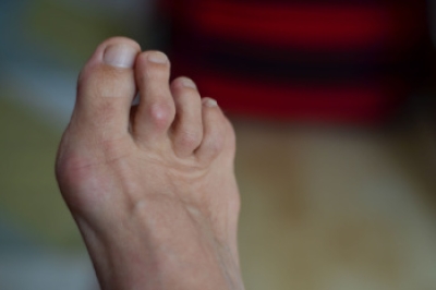 Hammertoe Deformities