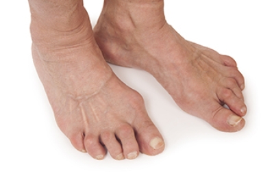 Rheumatoid Arthritis and Its Impact on the Feet