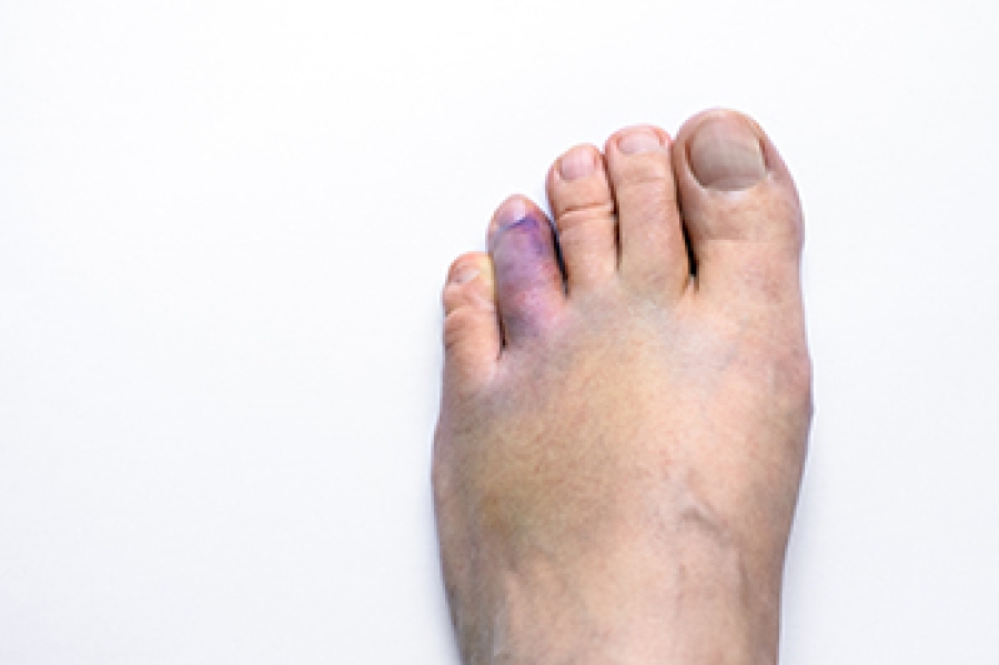 broken-toe-warning-signs