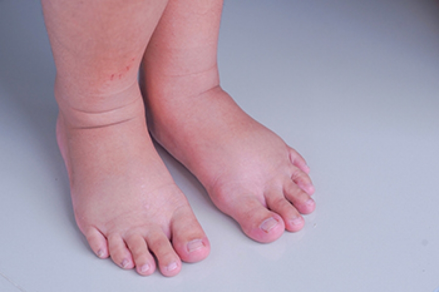 reasons-for-swollen-feet-during-pregnancy